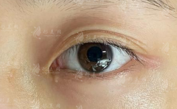 楊胤恒修復饅化口碑如何?術后靈動自然不僵硬!