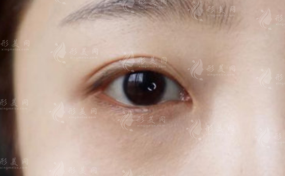 上海眼修復(fù)醫(yī)生排名前三?楊洪波高難度修復(fù)技術(shù)揭秘