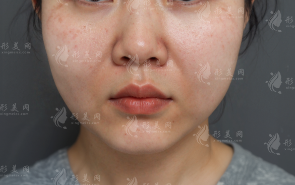 饅化臉修復多少錢?北上杭成價格+靠譜醫(yī)院醫(yī)生盤點