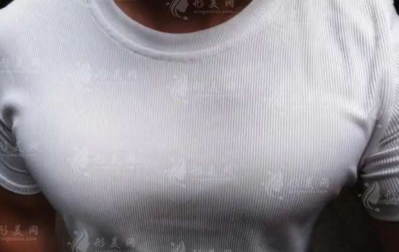 男性胸部整形哪里好?北京美萊廣州美萊技術(shù)解析