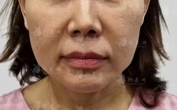 40歲臉下垂像發(fā)面饅頭?筋膜提升vs線雕怎么選!