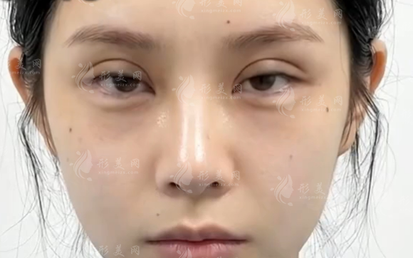 無錫雙眼皮修復(fù)找歐陽黎平靠譜嗎?技術(shù)價(jià)格全解析