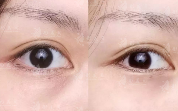 鄭州雙眼皮醫(yī)生排名前十!張芳申麗等十位技術(shù)大比拼