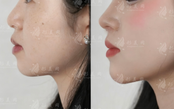 北京馮雁平隆鼻口碑怎么樣?媽生鼻技術(shù)好價(jià)格透明
