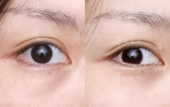 北京眼修復(fù)哪家好?晶美魏志香院長雙眼皮修復(fù)價格表及攻略全解析