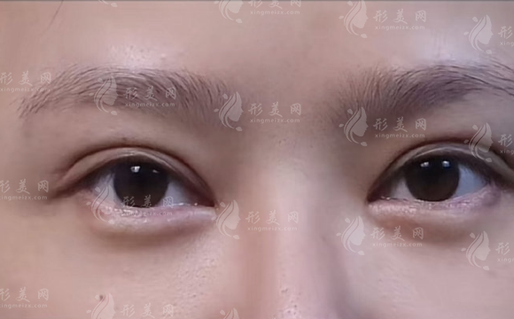 杭州雙眼皮修復哪家好?藝星和維多利亞技術(shù)大比拼!
