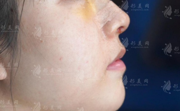隆鼻失敗怎么辦?鼻修復前這3件事必須搞清楚!