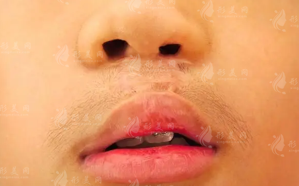毛喆醫(yī)生做唇裂修復(fù)好嗎?技術(shù)優(yōu)勢+適合人群全揭秘!
