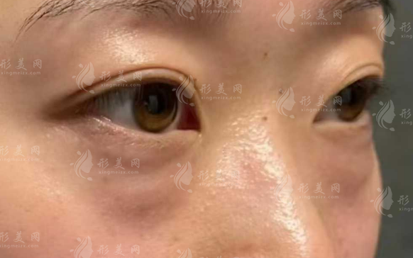 深圳祛眼袋醫(yī)院哪家好?這五家正規(guī)機(jī)構(gòu)口碑實(shí)力雙在線