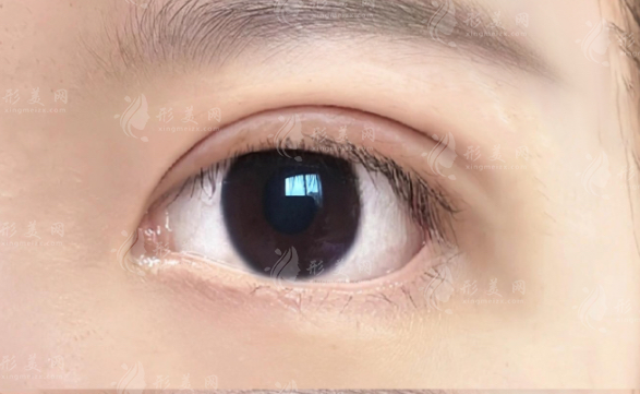 深圳秦王馳雙眼皮技術(shù)好嗎?媽生感風(fēng)格+價格全解析