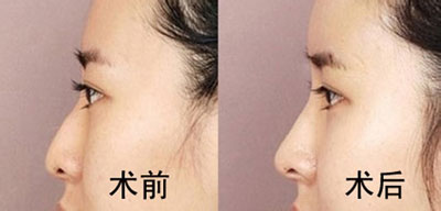 為什么隆鼻后會(huì)透光呢