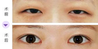 開(kāi)內(nèi)眼角有哪些禁忌癥跟適應(yīng)人群