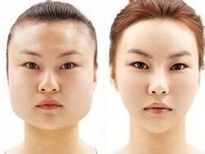 磨骨手術對比照 打造精致小臉