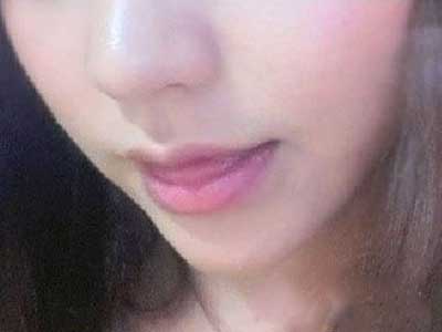 膨體豐下巴對比照 臉型更完美