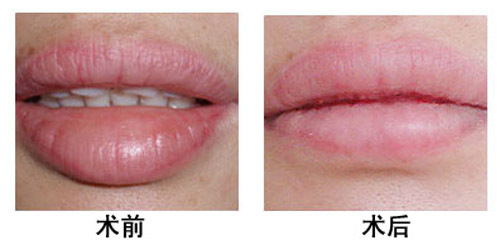 厚唇變薄是否存在副作用