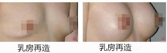 乳房再造術(shù)后注意事項