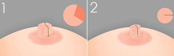 乳頭縮小術(shù)禁忌癥