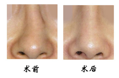 鼻骨矯正整形禁忌癥