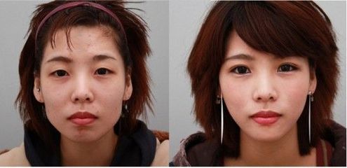 提眉術(shù)有風(fēng)險嗎