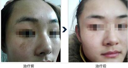 激光祛斑價(jià)格是多少