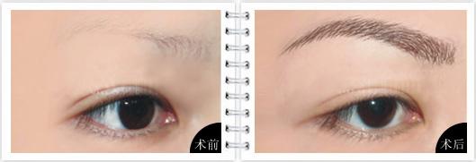 眉毛種植手術(shù)注意事項(xiàng)