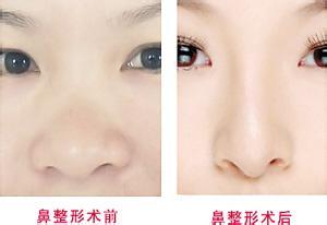 鼻翼縮小手術(shù)對比照
