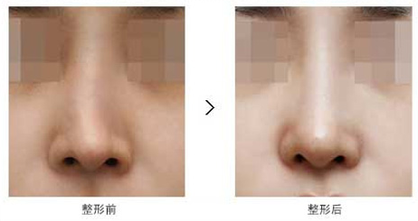 隆鼻失敗修復(fù)術(shù)后護(hù)理