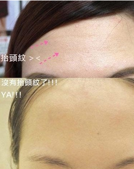 破尿酸去抬頭紋 翻倍年輕