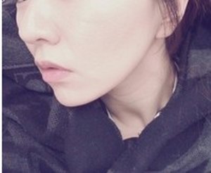 激光除皺 變小臉女神
