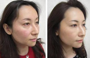 光子嫩膚去黑眼圈效果如何