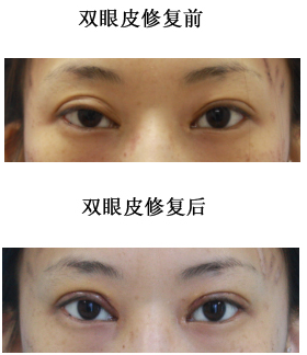 雙眼皮修復(fù)手術(shù)后護(hù)理