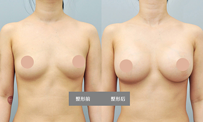 自體脂肪豐胸禁忌癥