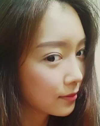 韓式雙眼皮+韓式隆鼻 精致的臉龐好迷人
