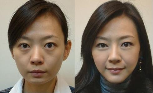 假體豐太陽穴效果如何