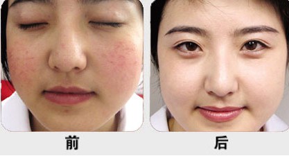 激光祛紅血絲優(yōu)勢有哪些