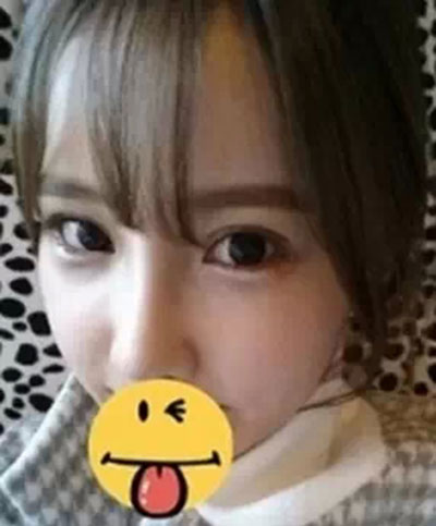雙眼皮+隆鼻+自體脂肪填充  回頭率百分百美女
