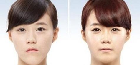 地包天矯正有哪些手術(shù)方法