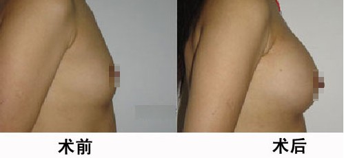 乳頭縮小價(jià)格是多少