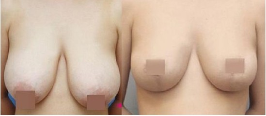 影響巨乳縮小術(shù)價格的因素