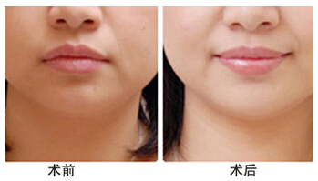 厚唇變薄手術(shù)費(fèi)用多少