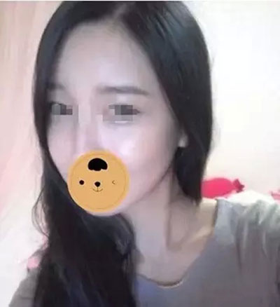玻尿酸豐額頭+蘋果肌 活出最美的自己