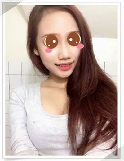 肉毒素瘦臉+玻尿酸豐下巴 變性感女神