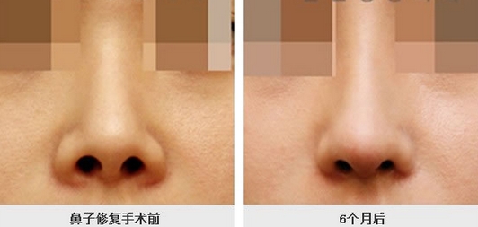 隆鼻失敗修復(fù)手術(shù)費(fèi)用是多少