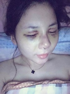隆鼻+全切雙眼皮 美到無法呼吸 - 珍美網(wǎng)