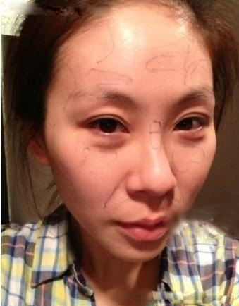 【自體脂肪豐面頰+豐額頭+豐太陽穴】對比照 御姐范杠桿的 - 珍美網(wǎng)