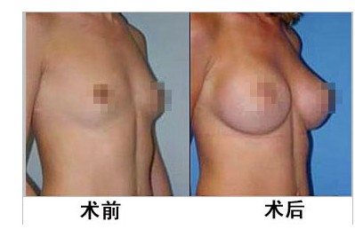 假體隆胸手術(shù)效果如何