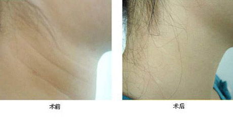 激光除皺術(shù)后如何護(hù)理 - 珍美網(wǎng)