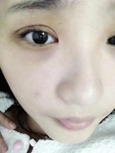 雙眼皮手術(shù) 讓自己更加甜美可愛 - 珍美網(wǎng)