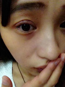 雙眼皮手術(shù) 讓自己更加甜美可愛 - 珍美網(wǎng)