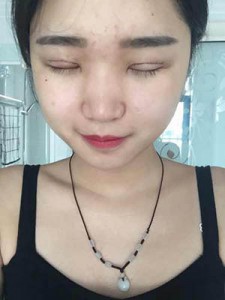 全切雙眼皮 開啟心靈之窗 - 珍美網(wǎng)
